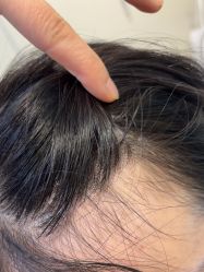 -碧莲盛·不剃发植发