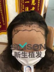 点击看大图 -新生植发·植养护一体