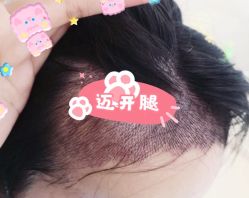 -大麦微针植发全国连锁