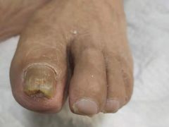 -祖传修脚甲沟炎灰指甲鸡眼
