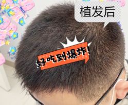 -大麦微针植发全国连锁