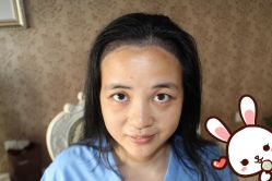 -大麦微针植发丨全国连锁