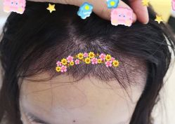 -大麦微针植发全国连锁