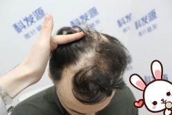 -大麦微针植发丨全国连锁