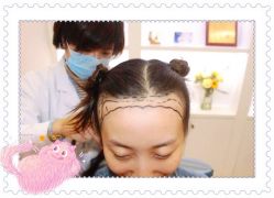 体验后-大麦微针植发全国连锁