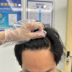 -大麦微针植发丨全国连锁
