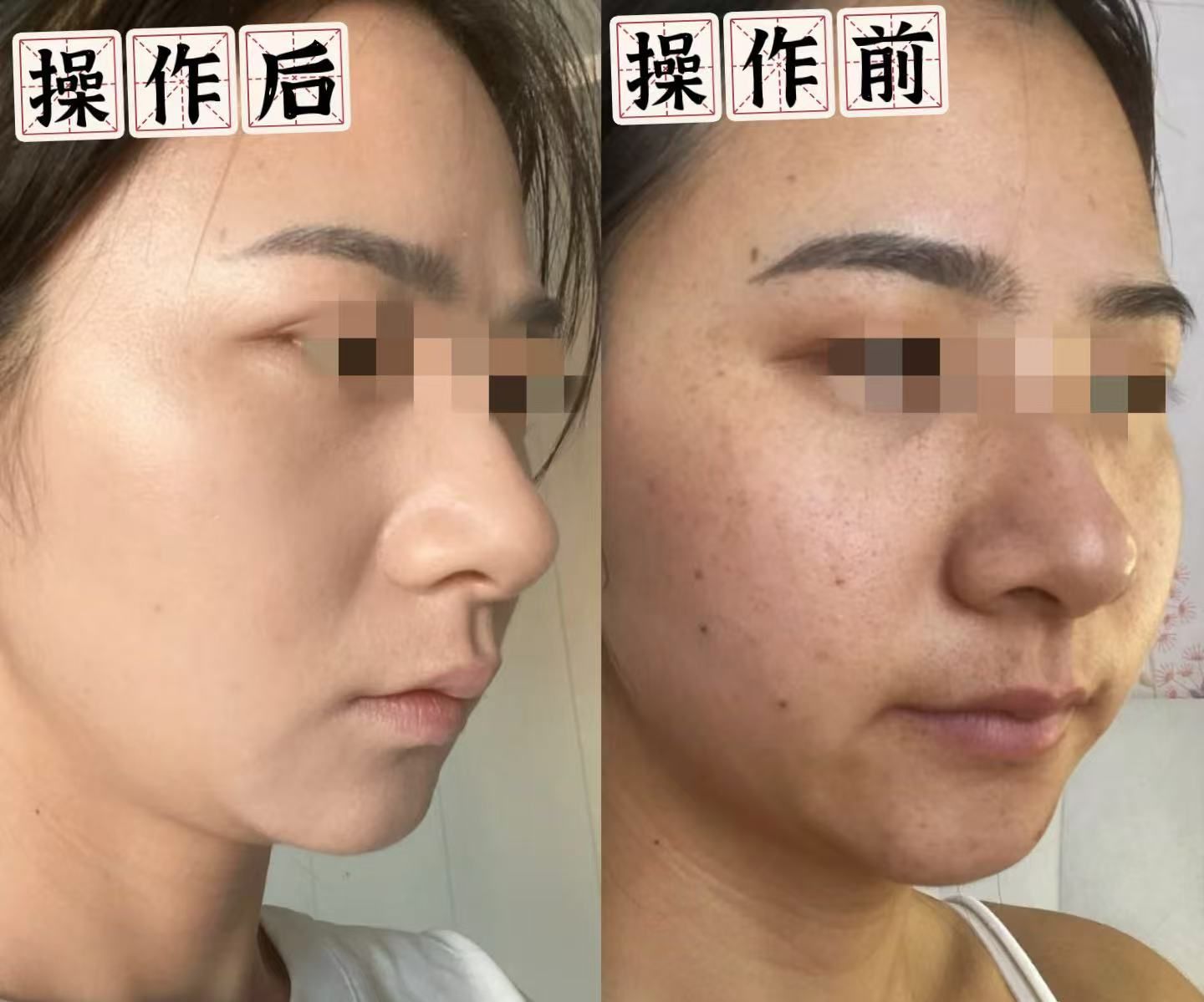 看我黄金微针真实效果对比!