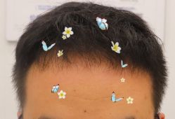 -大麦微针植发全国连锁