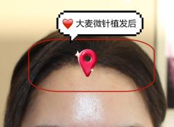 -大麦微针植发全国连锁