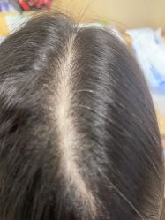 -碧莲盛·不剃发植发