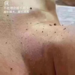 -瑶芳清颜草本祛痘