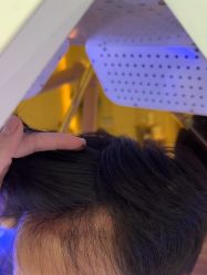 -碧莲盛·不剃发植发