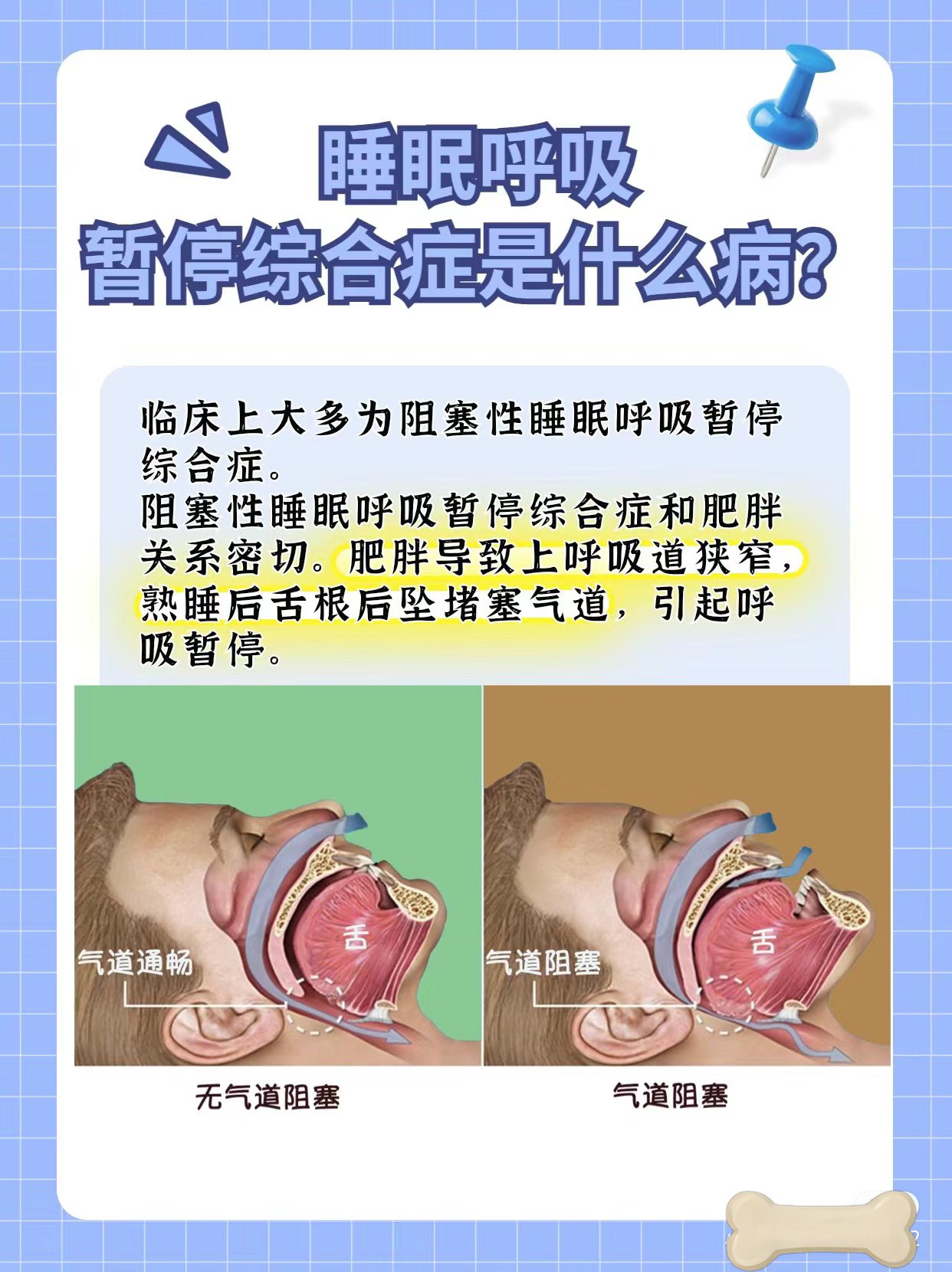 睡眠呼吸暂停综合症是什么病?