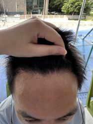 -大麦微针植发全国连锁