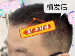 -大麦微针植发全国连锁