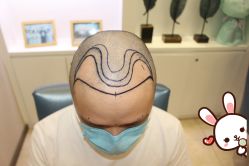 -大麦微针植发丨全国连锁