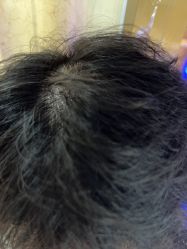 -碧莲盛·不剃发植发