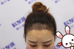 -大麦微针植发丨全国连锁