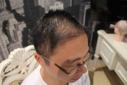 点击看大图 -大麦微针植发丨全国连锁