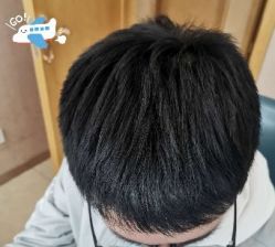 -大麦微针植发丨全国连锁