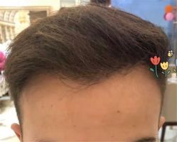 点击看大图 -大麦微针植发全国连锁