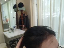 -碧莲盛·不剃发植发