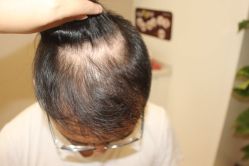 点击看大图 -大麦微针植发丨全国连锁