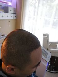 点击看大图 -大麦微针植发丨全国连锁