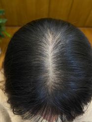 -大麦微针植发全国连锁