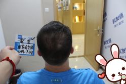 -大麦微针植发丨全国连锁