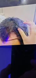 -碧莲盛·不剃发植发