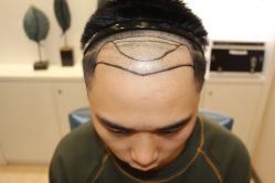 -大麦微针植发丨全国连锁