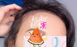 -大麦微针植发全国连锁