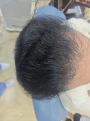 -大麦微针植发全国连锁