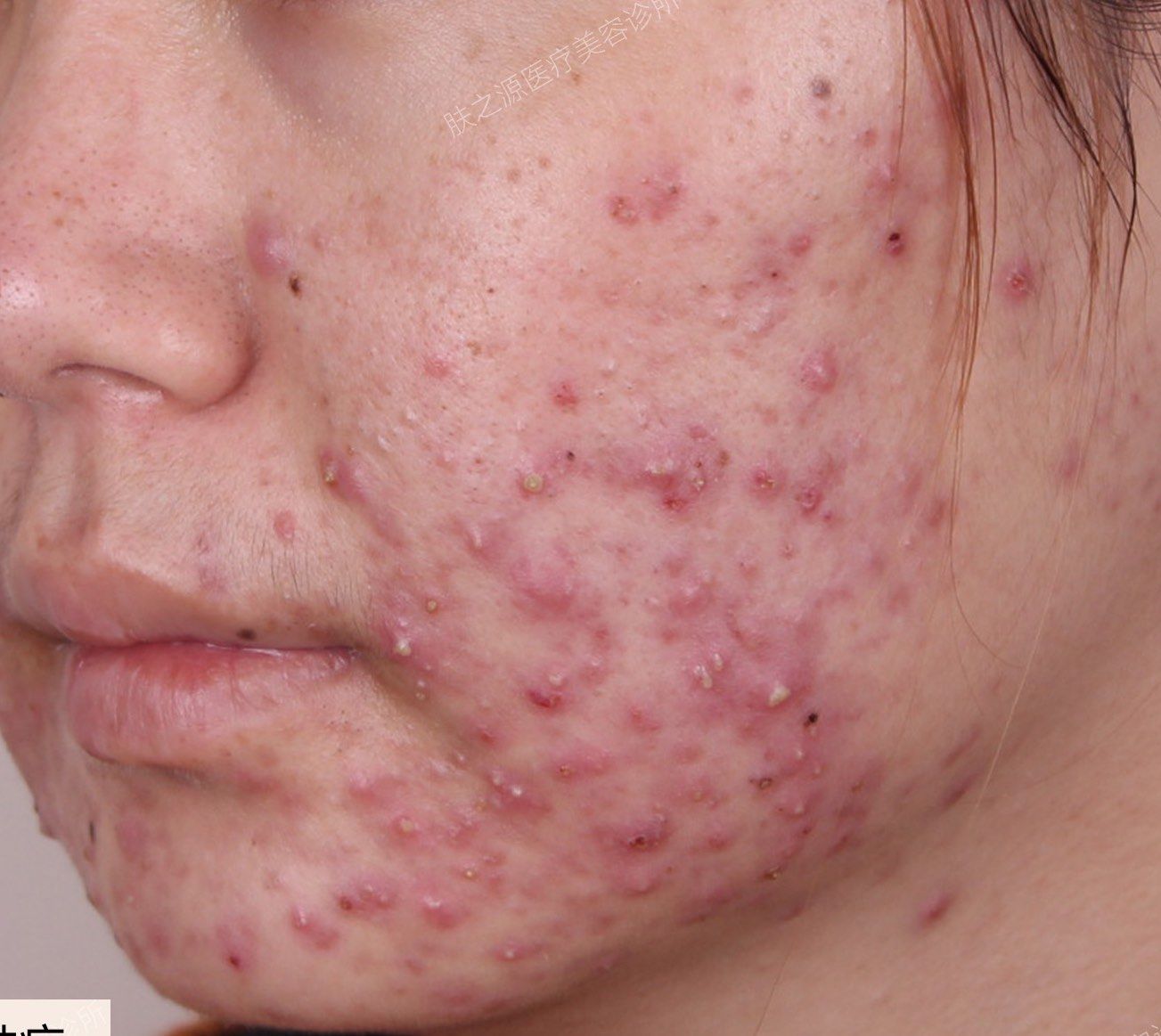 你以为这是青春痘?
