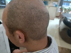 -碧莲盛·不剃发植发