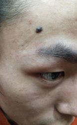 体验前-北京美痣堂古方祛痣斑疣瘊