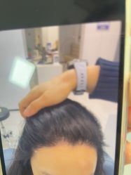 -大麦微针植发丨全国连锁