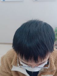 -大麦微针植发丨全国连锁