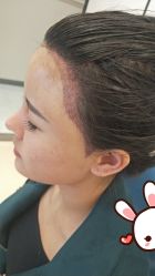 点击看大图 -大麦微针植发丨全国连锁