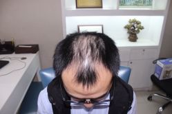 -大麦微针植发全国连锁