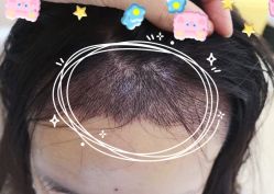 -大麦微针植发全国连锁