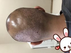 点击看大图 -大麦微针植发丨全国连锁