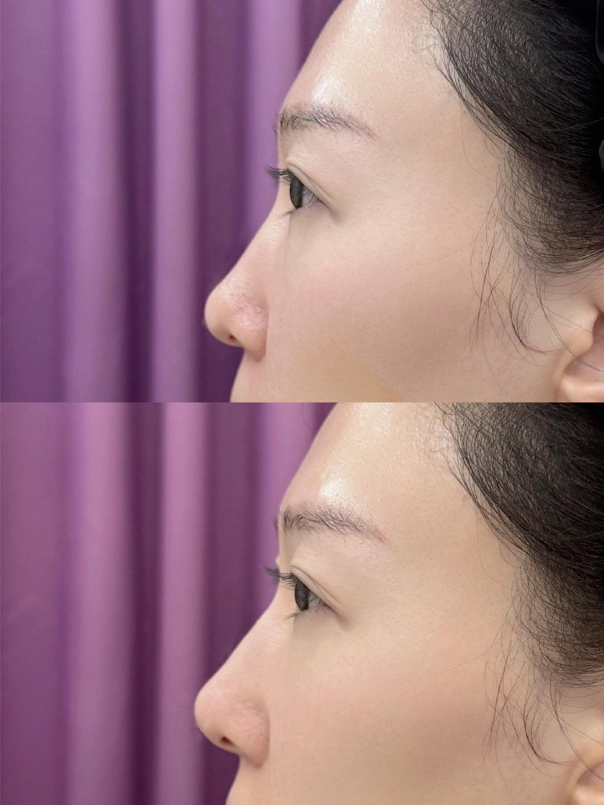 但缺点在山根高度不够,鼻背与眉心三角区的衔接度缺失