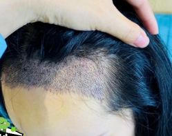 -大麦微针植发丨全国连锁