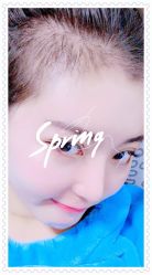 体验后-大麦微针植发全国连锁