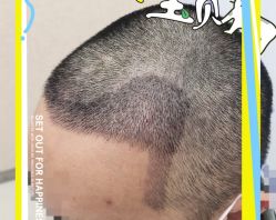 -大麦微针植发全国连锁