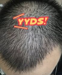 -大麦微针植发丨全国连锁