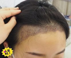 -大麦微针植发丨全国连锁