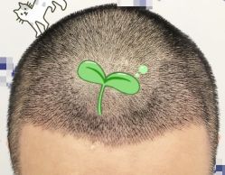 -大麦微针植发全国连锁